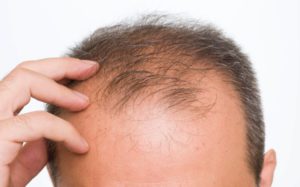 Calvitie homme